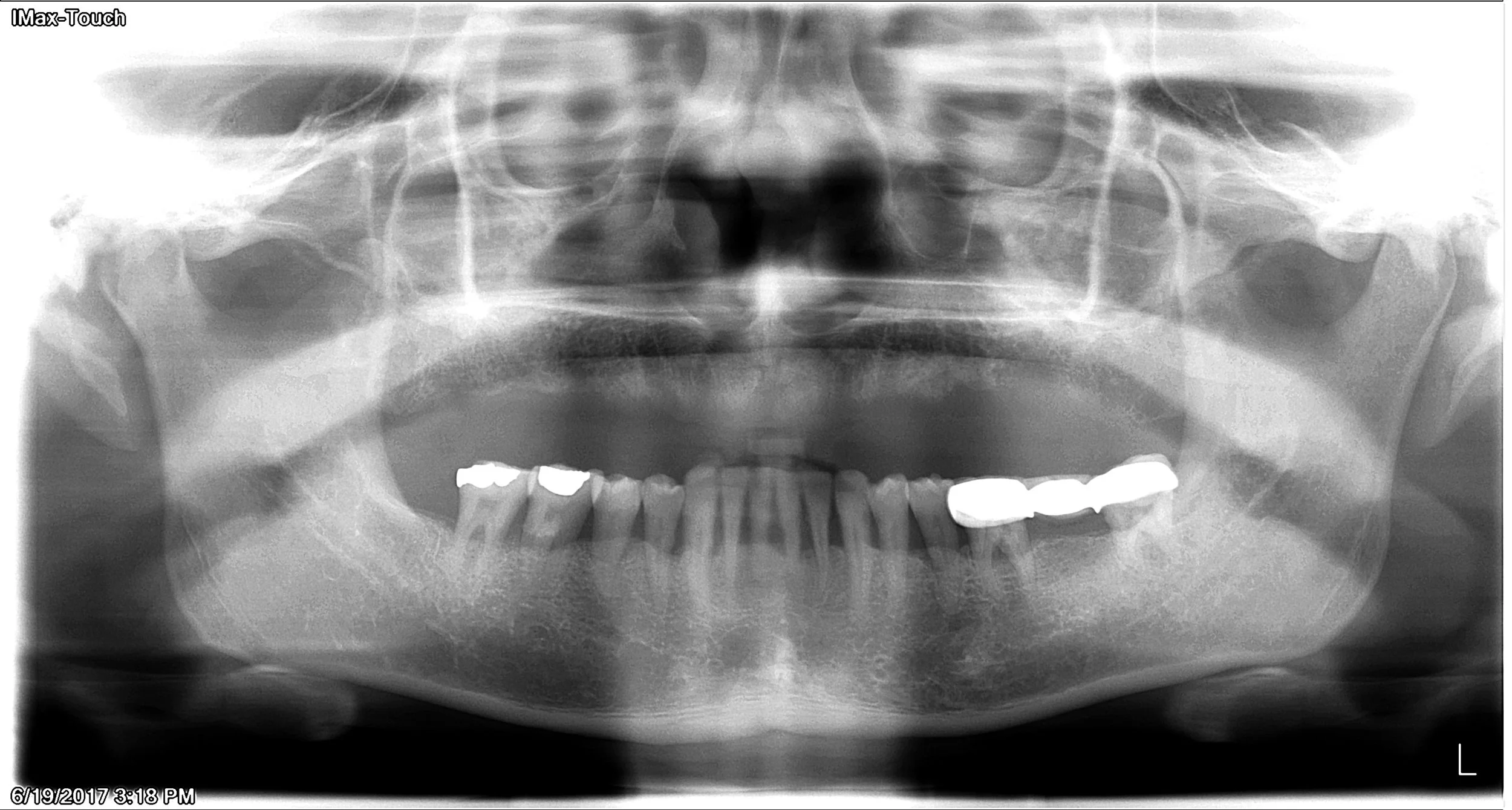 Before - Patient states not being able to eat steak for years.