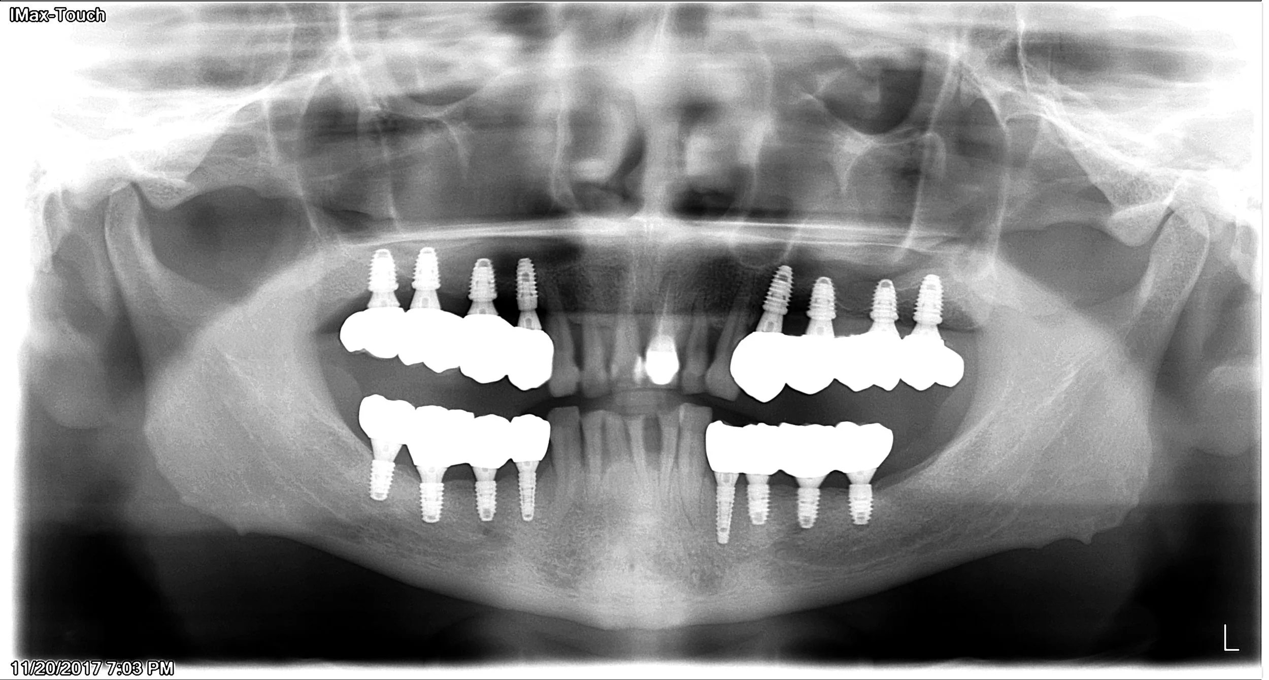 After - implants was placed on back teeth to restore function and maintain vertical dimension and facial musculature; Patient plans to get dental implants on front teeth in 2-3 years and budget allows.