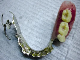 Unilateral partial denture - Denture replacing one side of back teeth only