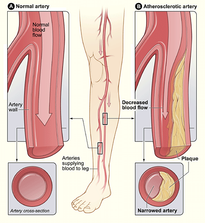 Angioplasty- In this procedure, a small hollow tube (catheter) is threaded through a blood vessel to the affected artery. There, a small balloon on the tip of the catheter is inflated to reopen the artery and flatten the blockage into the artery wall, while at the same time stretching the artery open to increase blood flow. Your doctor may also insert a mesh framework called a stent in the artery to help keep it open. 