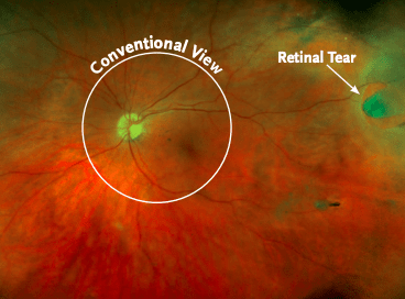 Optos-retinal-tear.png