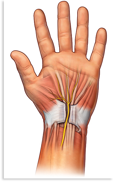Swelling in the carpal tunnel may compress the median nerve, causing CTS. Surgical treatments cut the transverse carpal ligament to make room for the nerve. Eventually new tissue will fill the gap where the ligament was cut.