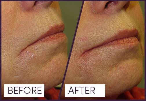 Dermal Filler to lift downward turn of lip