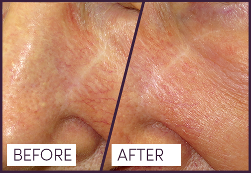 Treatment for Facial Veins