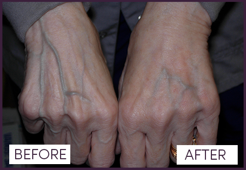 Left Hand Post Filler, Right Hand Untreated