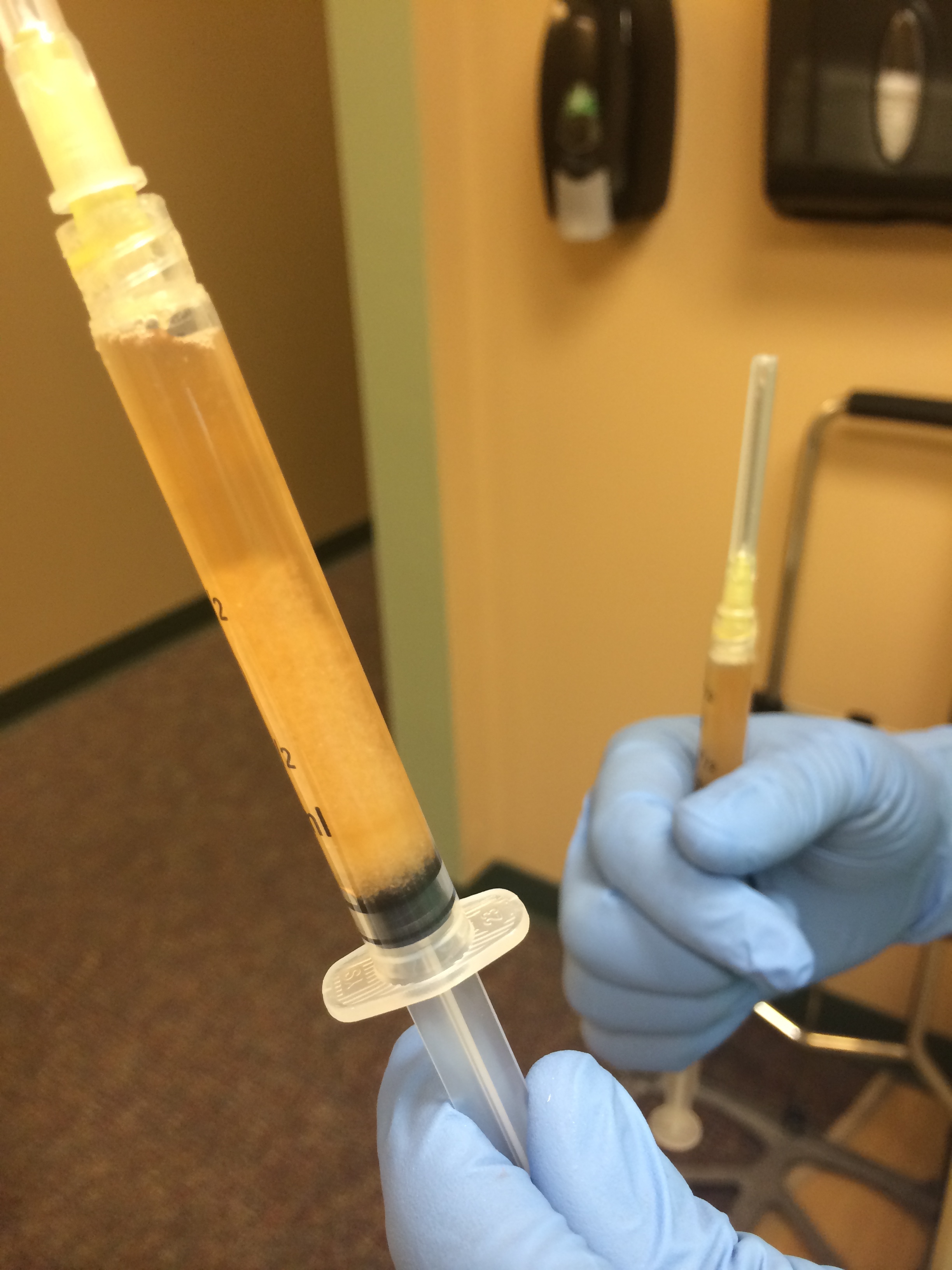 Photograph of Platelet rich plasma injection mixed with Matristem prior to injection into a patient with Empty Nose Syndrome visiting us from Italy.