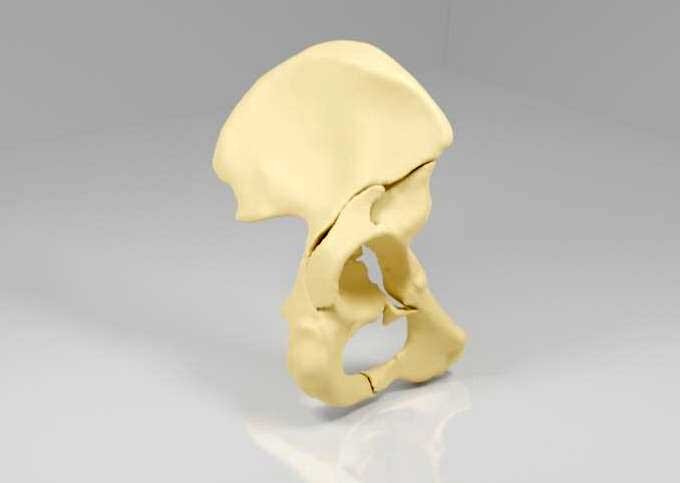 lium with acetabular fracture- patient-specific hip model