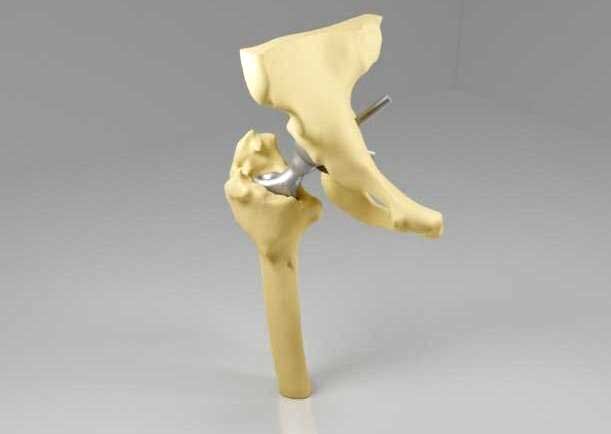 Hip-TEP revision - anatomical model with implant