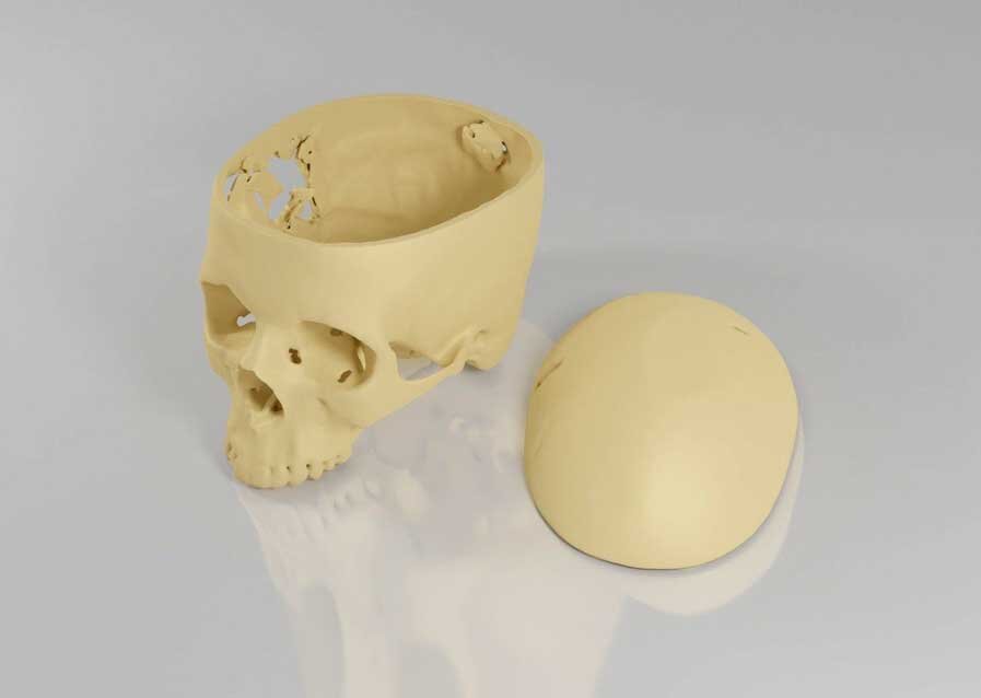 pre-op skull model - cranial vault separated