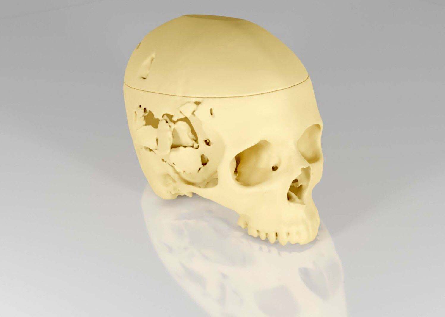 pre-op skull anatomical model