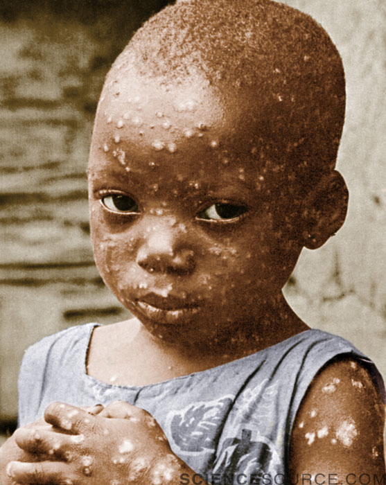 Child With Smallpox