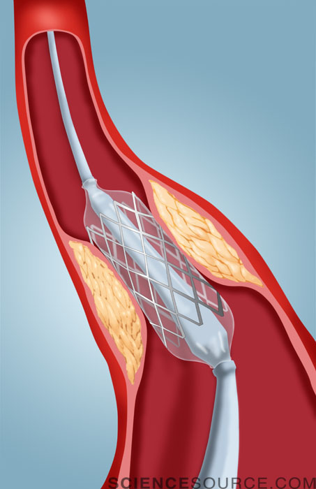 Angioplasty with Stent