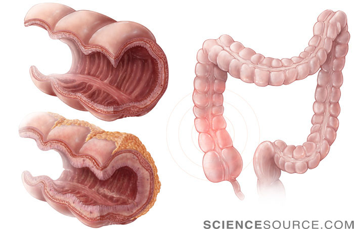 Crohn's Disease Progression