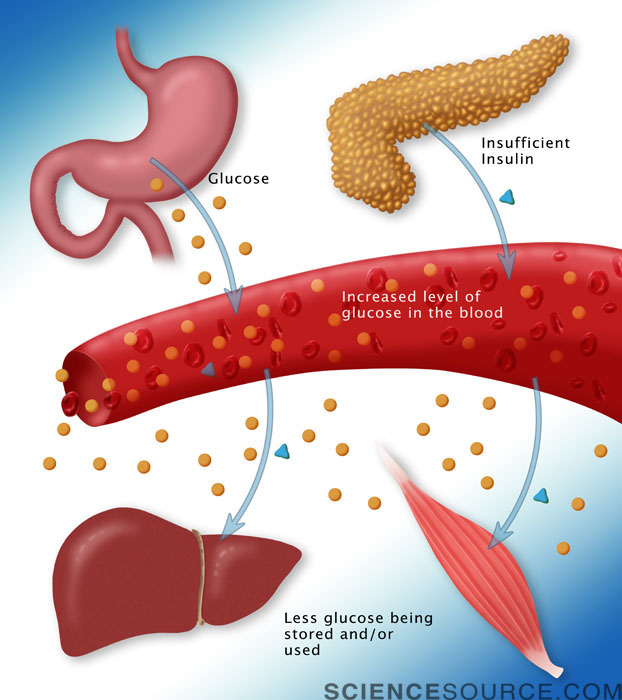 Type I Diabetes