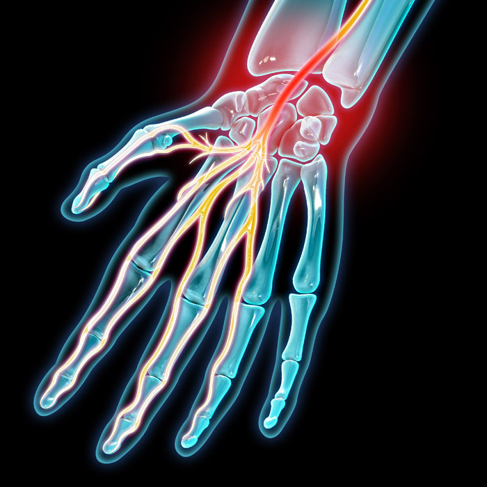 Carpal Tunnel Syndrome, Illustration