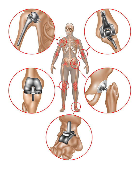 Joint Replacement