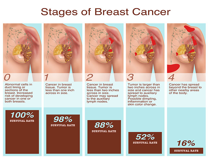 Breast Cancer Stages