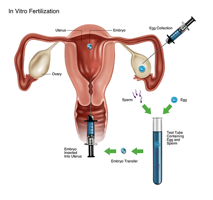 In Vitro Fertilization