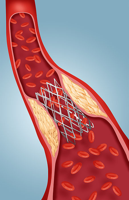 Stent in Artery