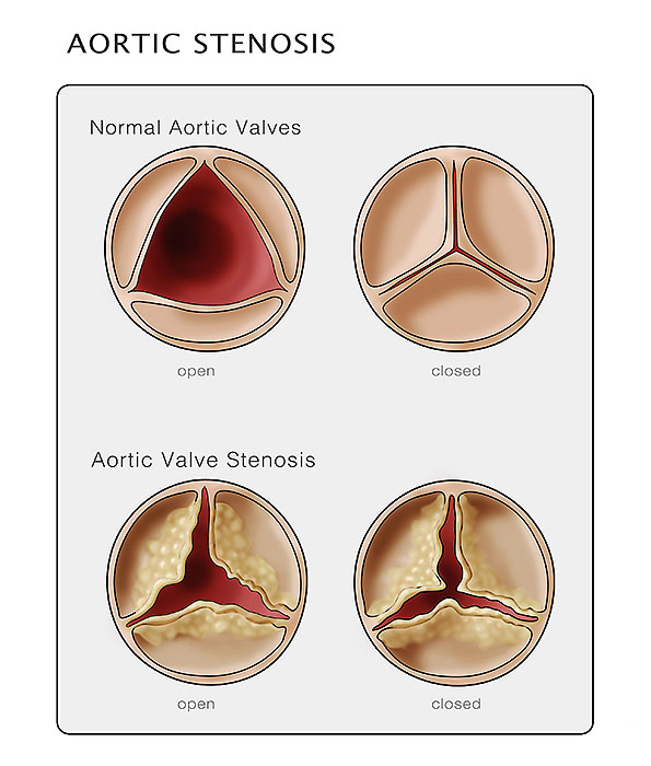 Aortic Valve &amp; Stenosis