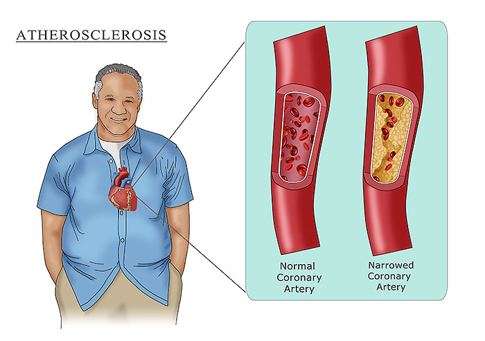 Heart Disease