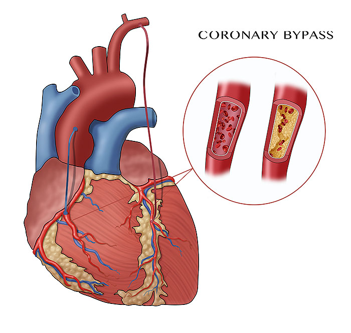 Coronary Bypass