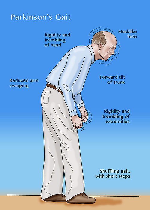 Parkinson's Disease