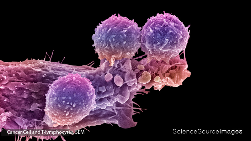 CANCER CELL AND T LYMPHOCYTES, SEM