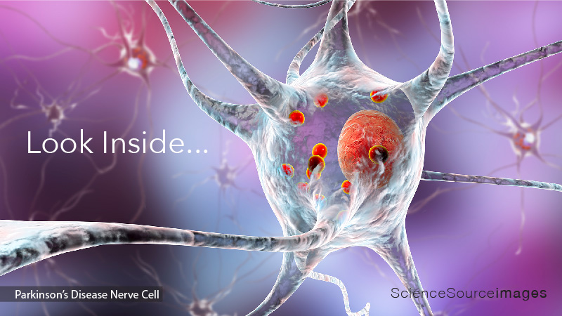 Parkinson's disease nerve cells, illustration 