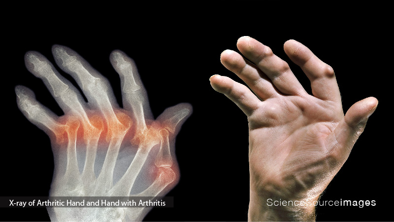 X-Ray and Photo of Arthritic Hand