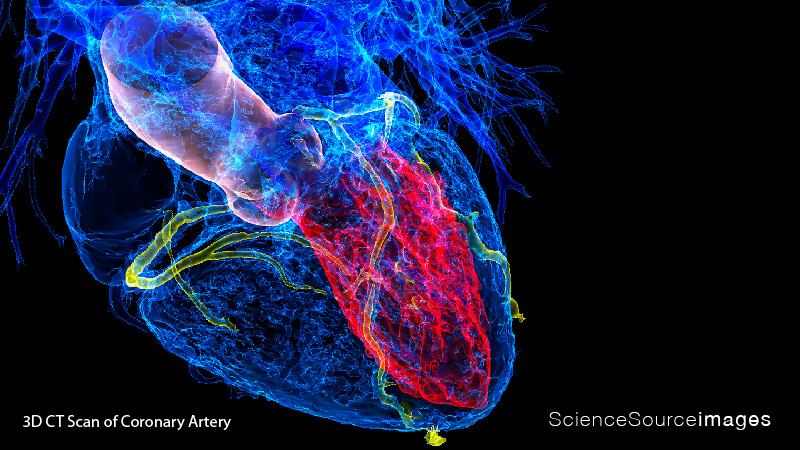 HEART IN CORONARY ARTERY DISEASE, 3D CT SCAN