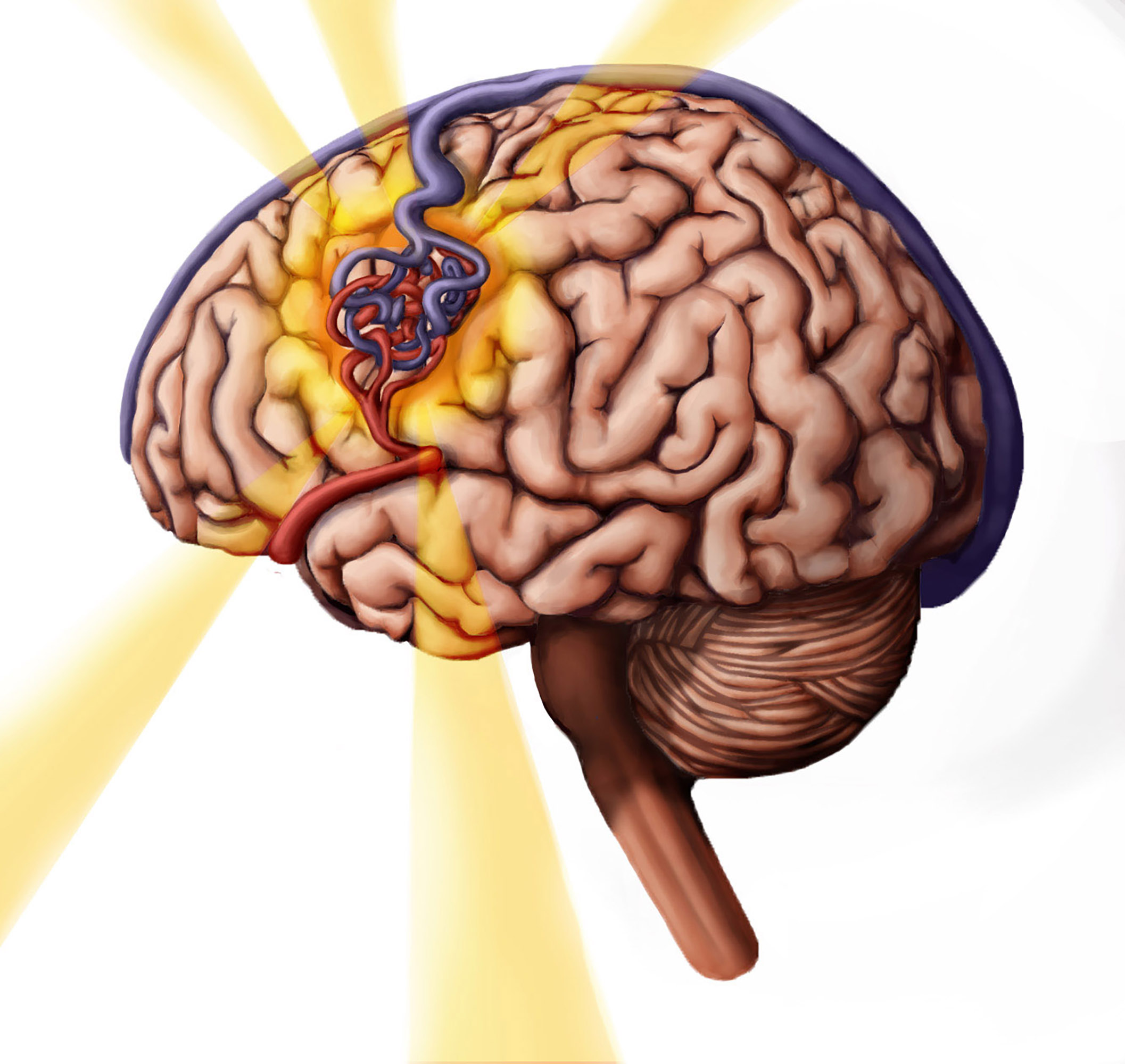 Arteriovenous Malformation, Illustration