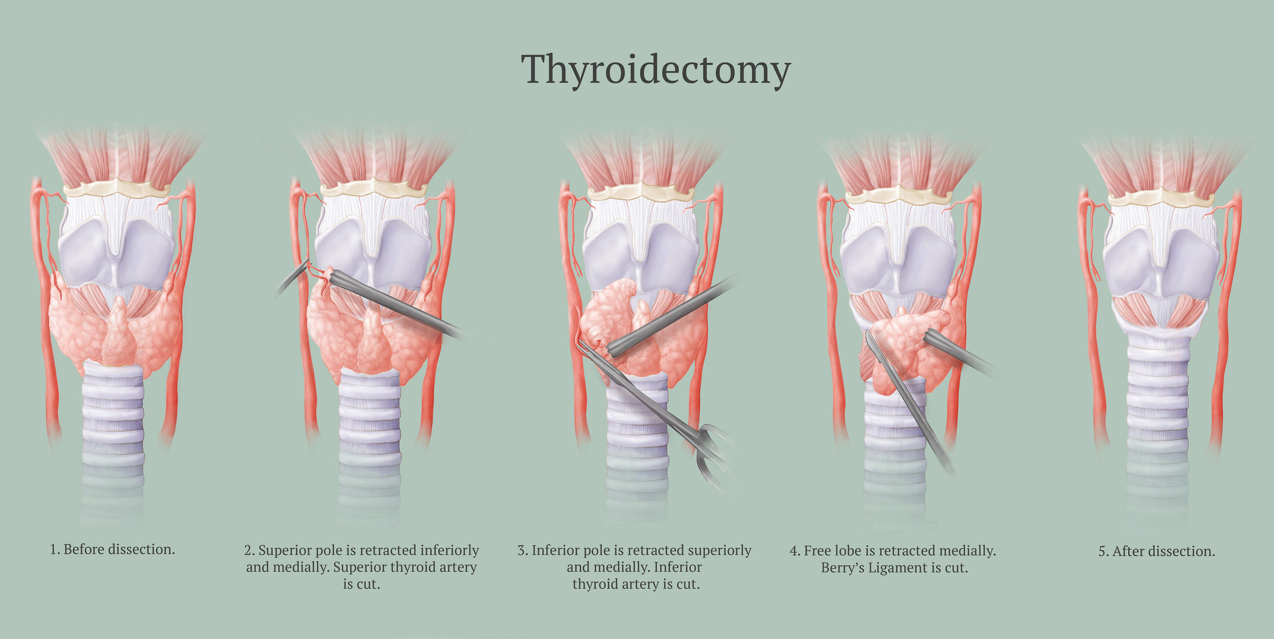 Thyroidectomy Procedure, Illustration