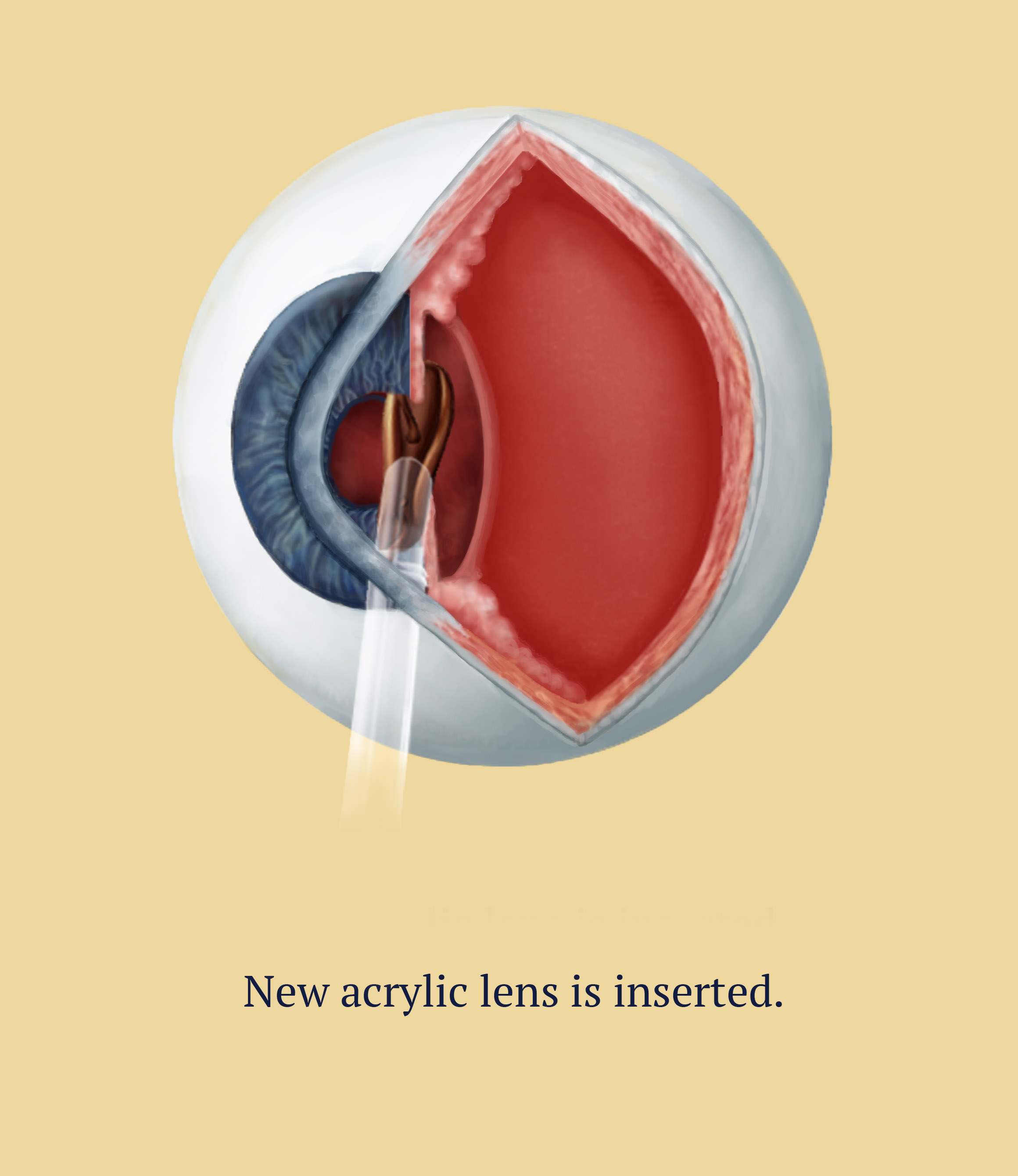 Cataract Surgery, 4 of 6, Illustration