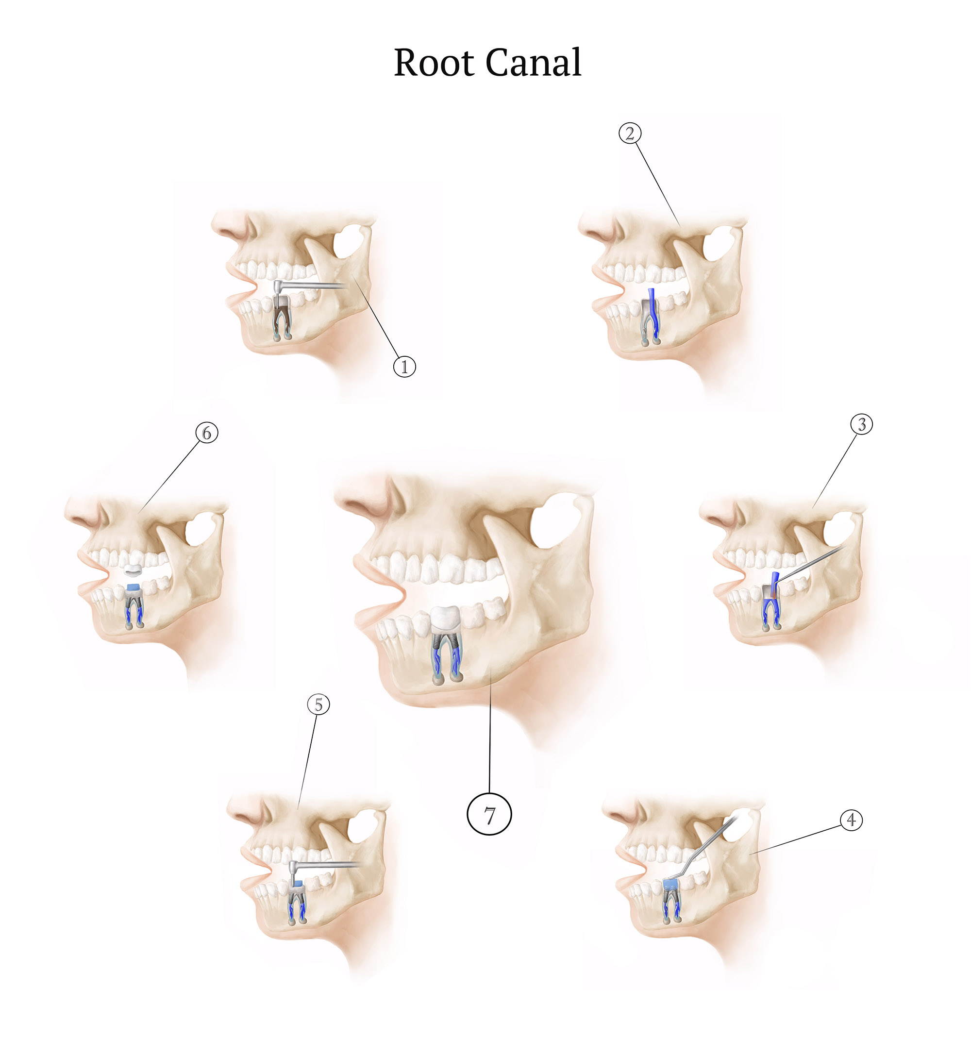 Root Canal Procedure, Illustration