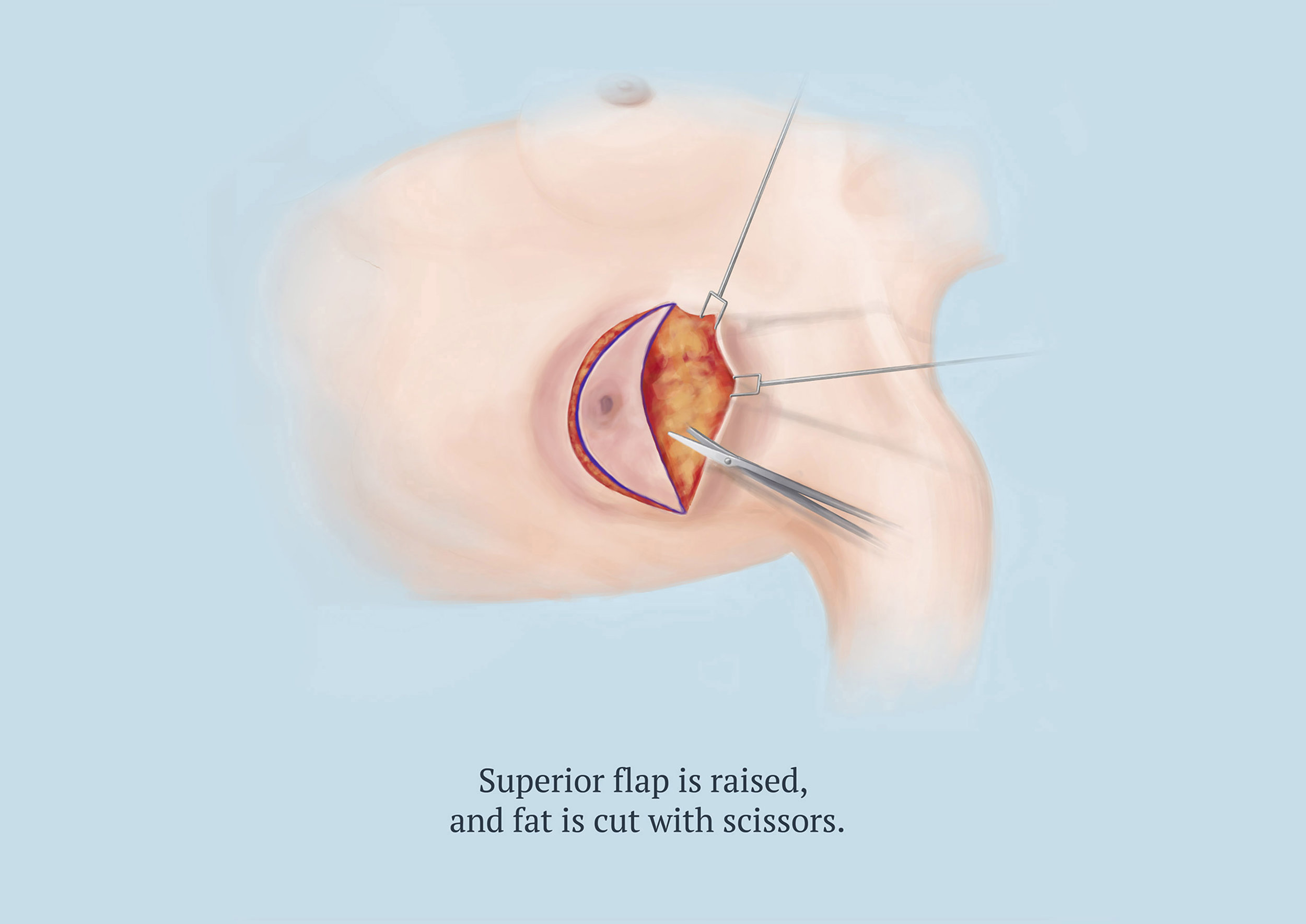 Mastectomy, Step 4 of 8, Illustration