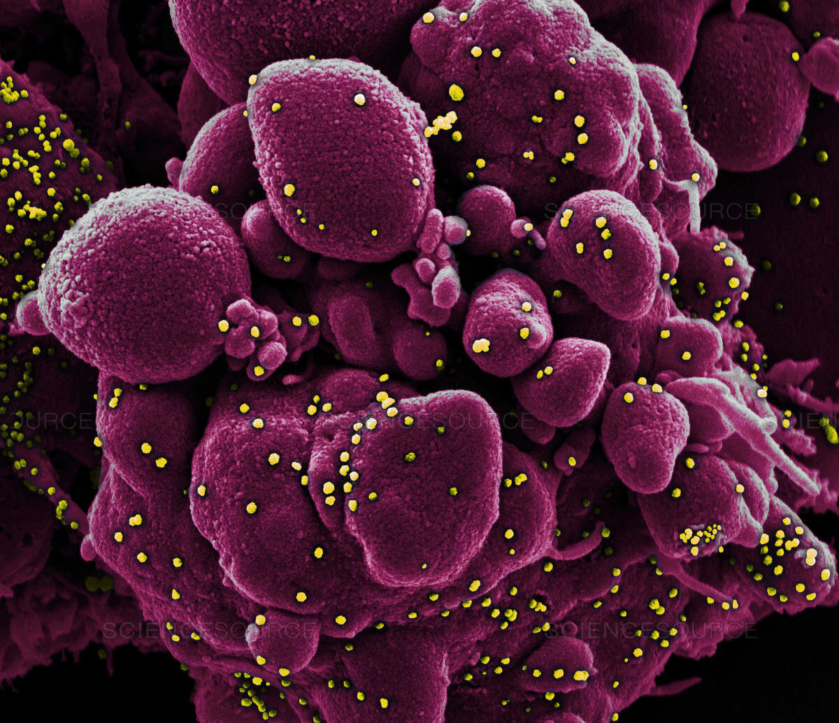 Apoptotic cell with SARS-COV-2