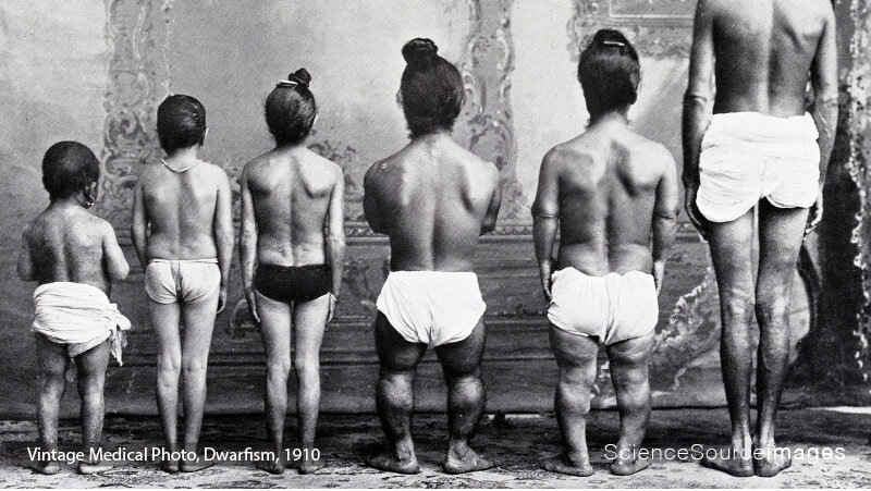 Vintage Medical Photograph, Dwarves 1910