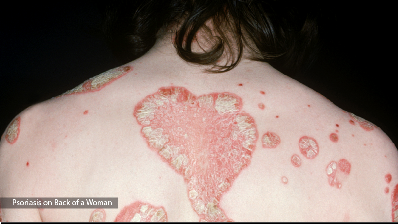 Psoriasis on Woman's Back