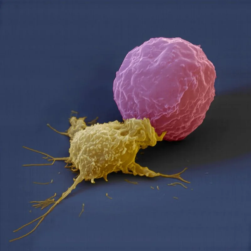 Cancer Cell, SEM, Microscopic Stock Photo