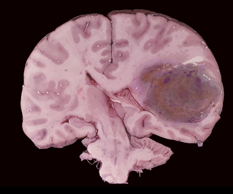 Brain Tumor Gross Specimen