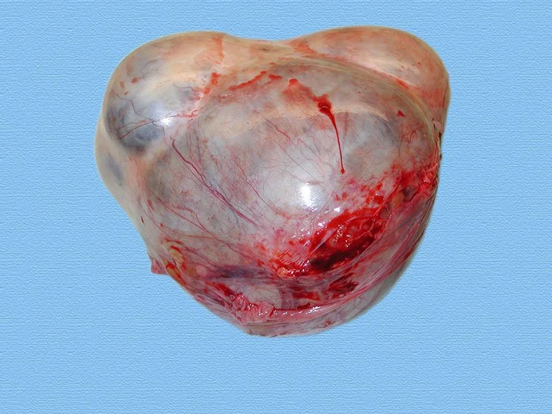 Gross Specimen, Ovarian Cancer