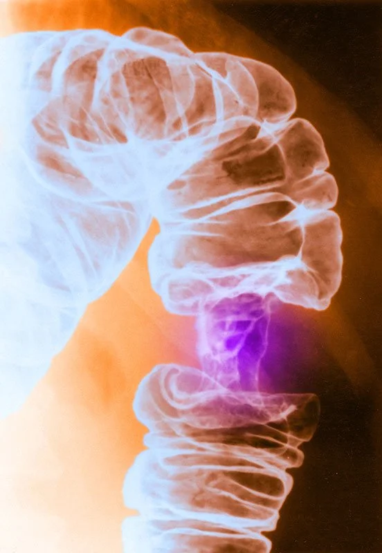 Xray, Colorectal Cancer