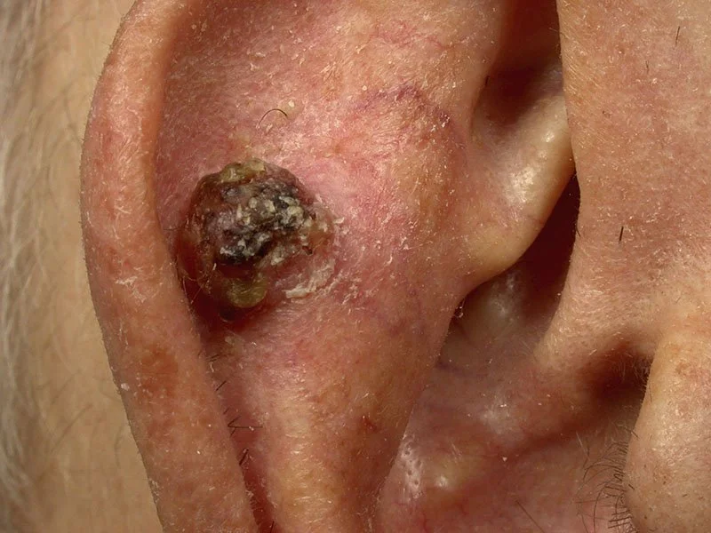 Cancer Gross Specimen