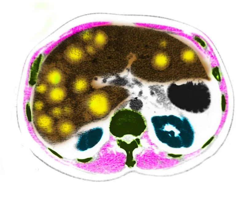 CT Scna, Metastatic Liver Cancer
