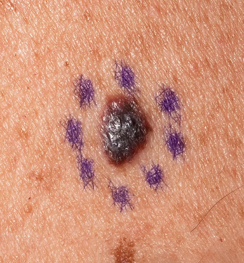 Skin Cancer Gross Specimen