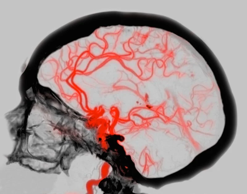 CT Scan, Brain Arteries
