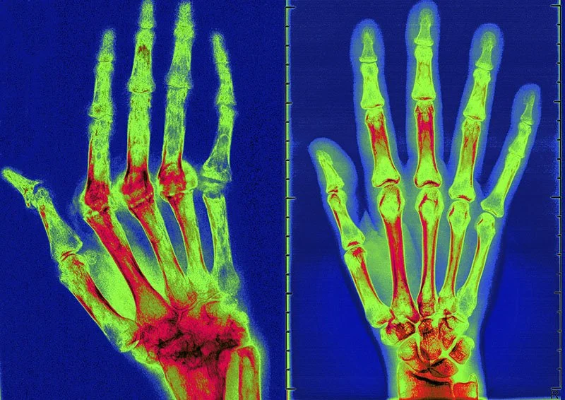 Rheumatoid Arthritis X-ray