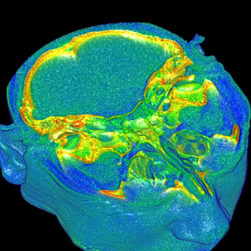 Axial MRI Brain Scan