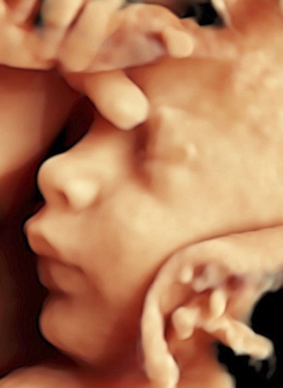 3D Ultrasound, Fetus in Womb